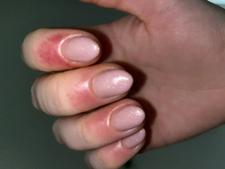 Gel nagellak allergie